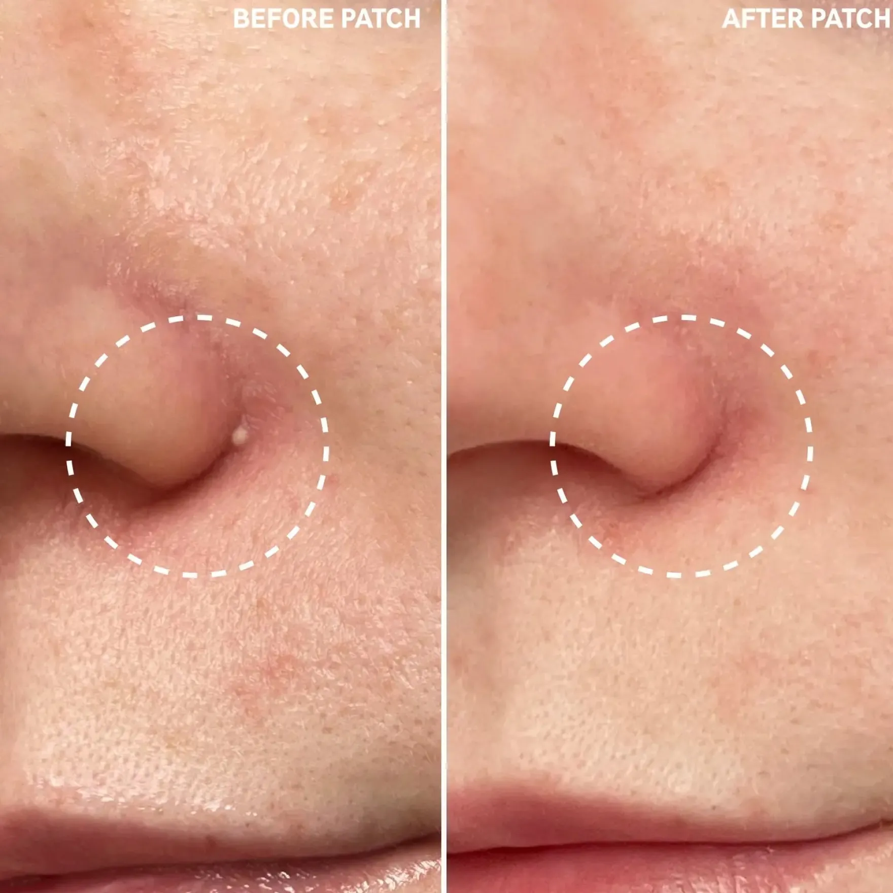 Hydrocolloid Invisible Pimple Patches