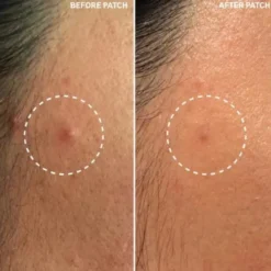 Hydrocolloid Invisible Pimple Patches