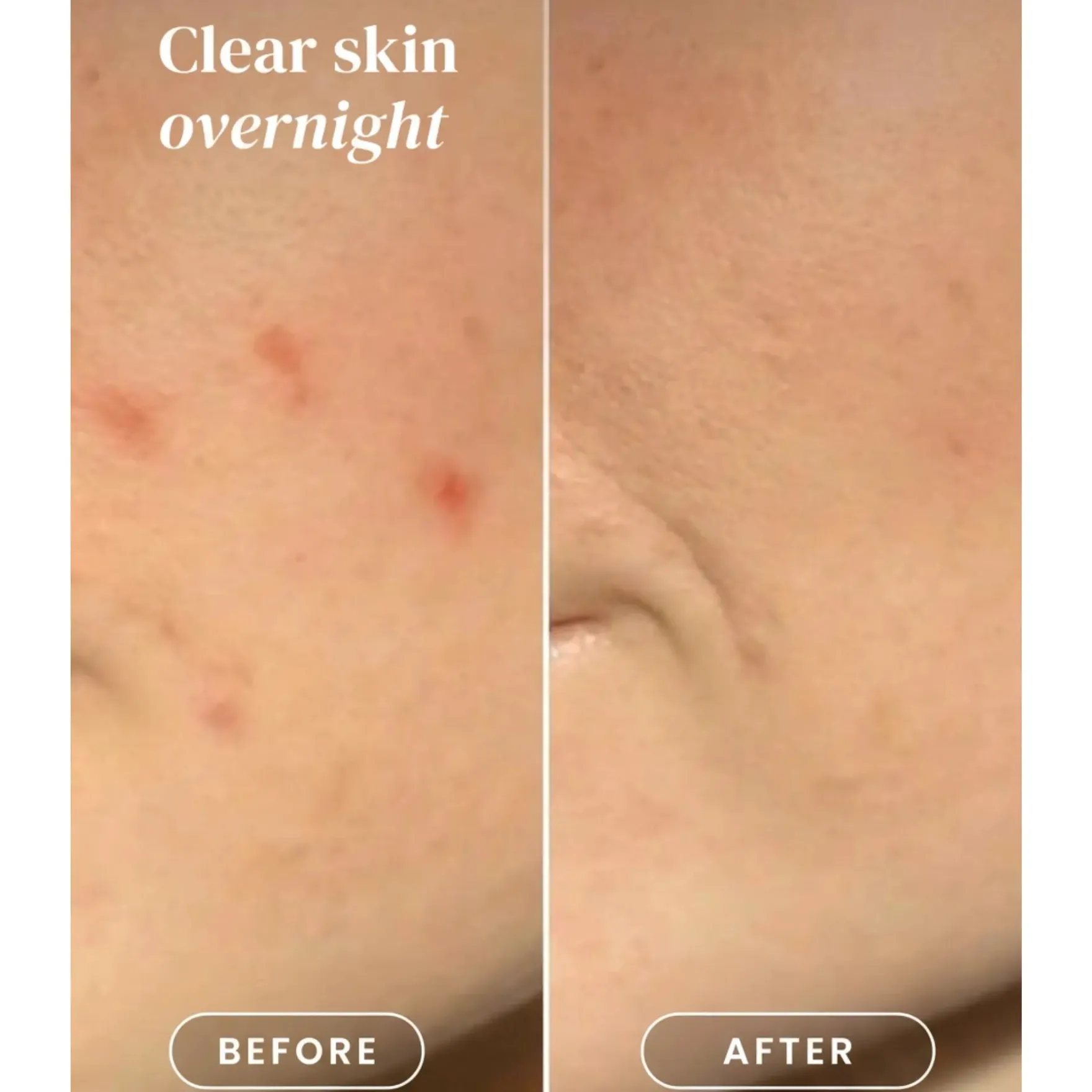 Pimple Patches