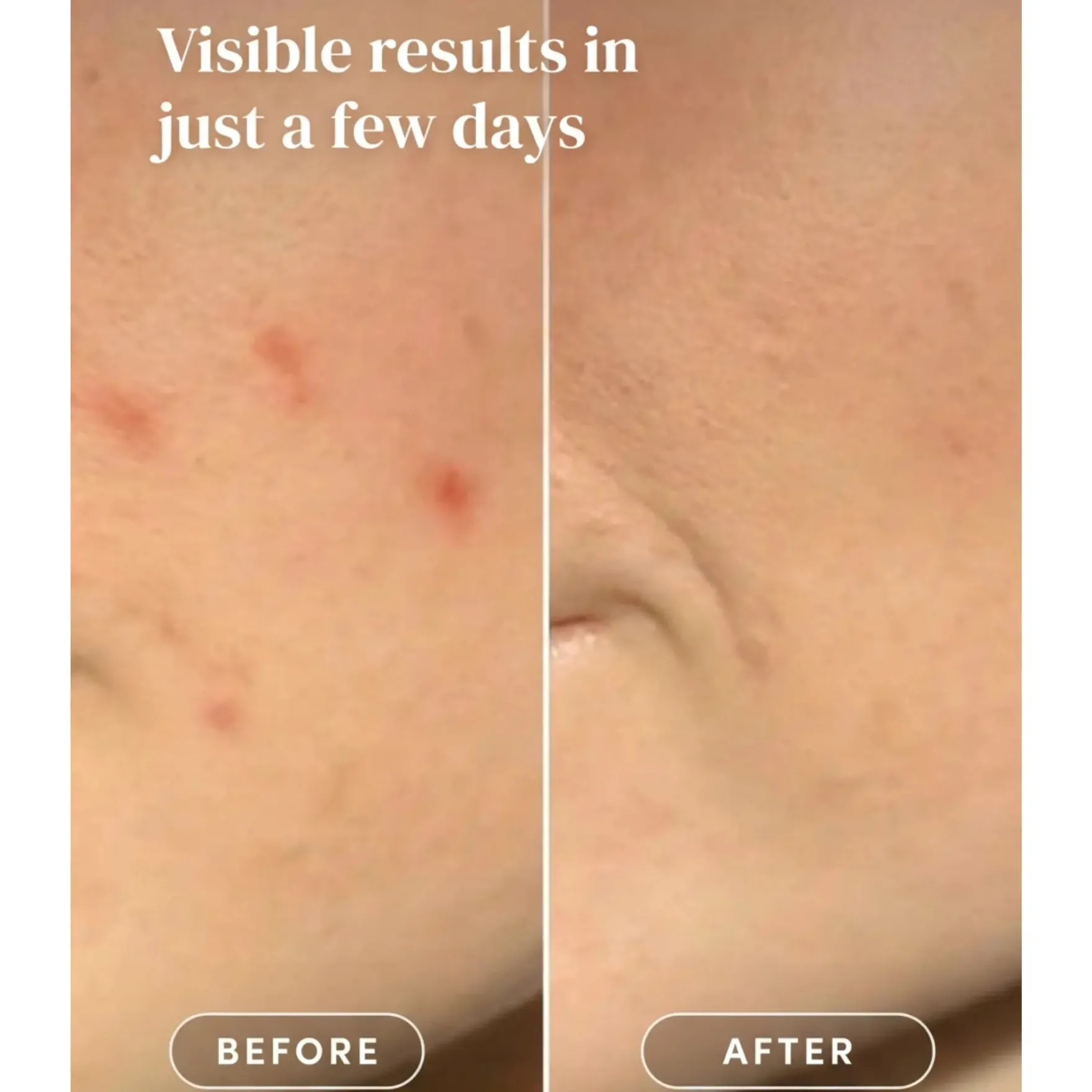 Post Pimple Patches