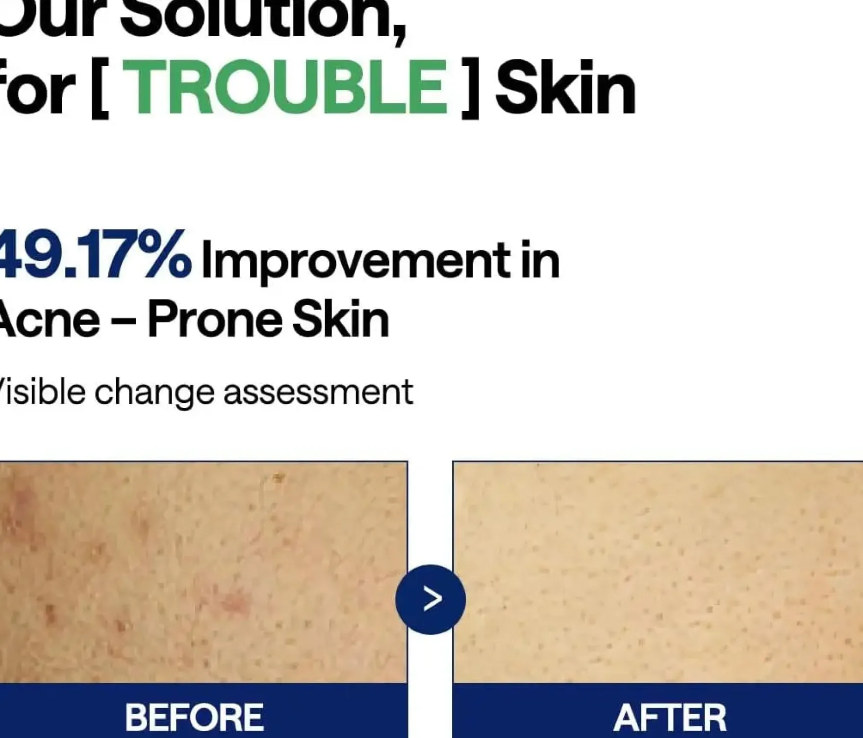 Teatree Trouble Pad