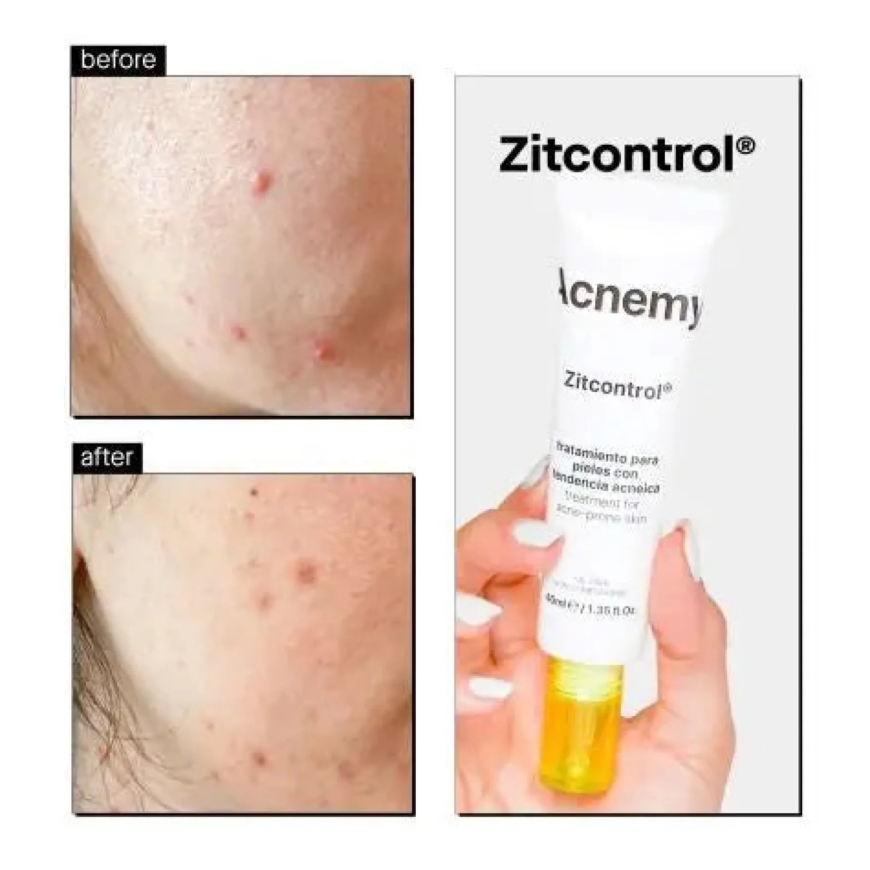 Zitcontrol Treatment Cream