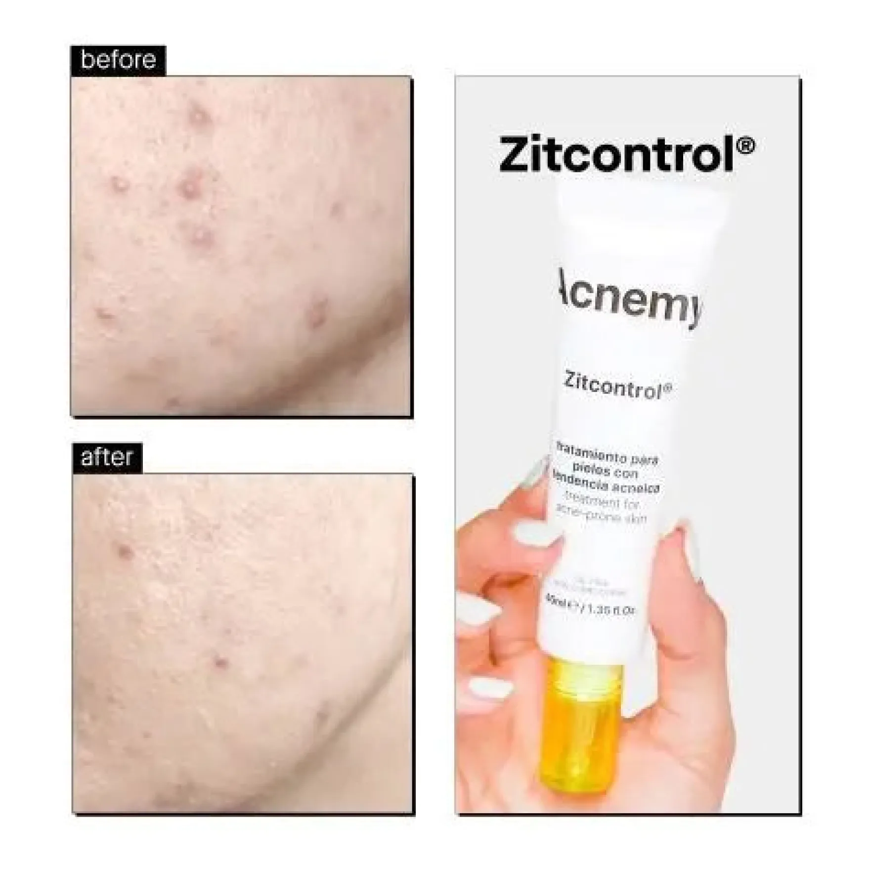 Zitcontrol Treatment Cream